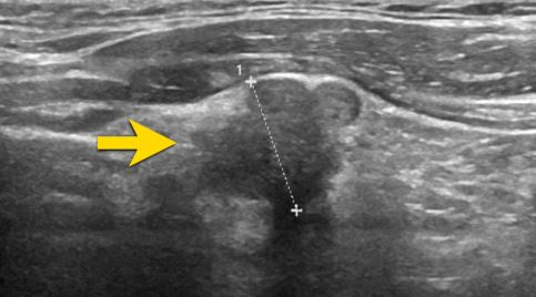 H&igrave;nh ảnh nh&acirc;n tuyến gi&aacute;p tr&ecirc;n si&ecirc;u &acirc;m