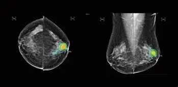 Sau khi đặt túi ngực có nên chụp X-quang và siêu âm vú?