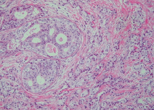 Giải phẫu bệnh ung thư vú – Cách đọc và hiểu kết quả