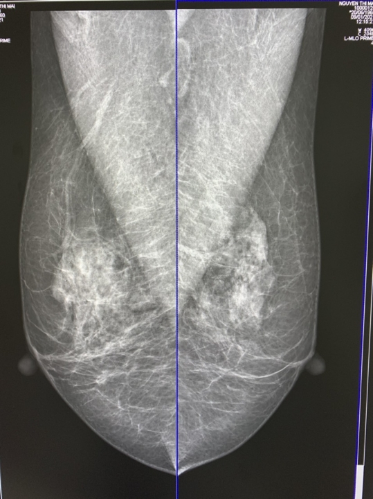 Chụp 3D Tuyến Vú (Digital Breast Tomosynthesis) – Bước Tiến Mới Trong Sàng Lọc Ung Thư Vú
