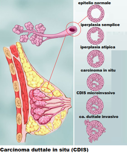 Ung thư biểu mô tuyến tại chỗ (DCIS) – Có thật sự nguy hiểm?