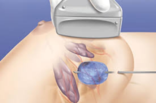 Bài 8: Kỹ thuật mới trong phẫu thuật ung thư vú – Cryoablation, Oncoplastic surgery và xu hướng tương lai