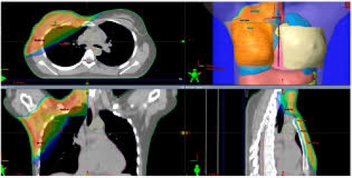 Bài 3: Các kỹ thuật xạ trị hiện nay trong ung thư vú (3D-CRT, IMRT, Proton Therapy)