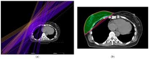 Bài 4: Tác dụng phụ của xạ trị ung thư vú và cách giảm nhẹ
