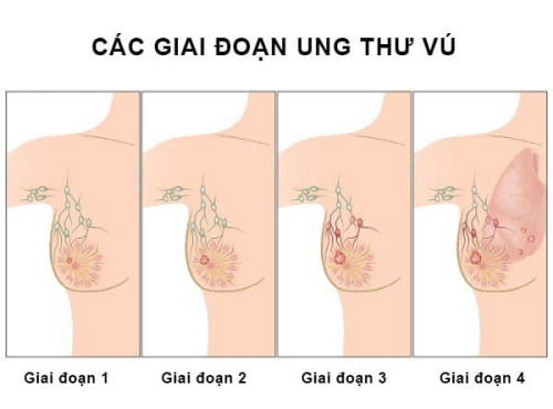 Các giai đoạn ung thư vú và chiến lược điều trị