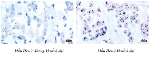 Ung thư vú HER2 dương tính – Tiên lượng và liệu pháp điều trị hiện nay