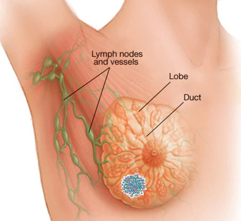Eribulin trong điều trị ung thư vú – Vũ khí mới trong giai đoạn di căn