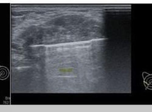 HÚT CHÂN KHÔNG LOẠI BỎ U VÚ (VABB) – GIẢI PHÁP AN TOÀN, THẨM MỸ, HIỆU QUẢ