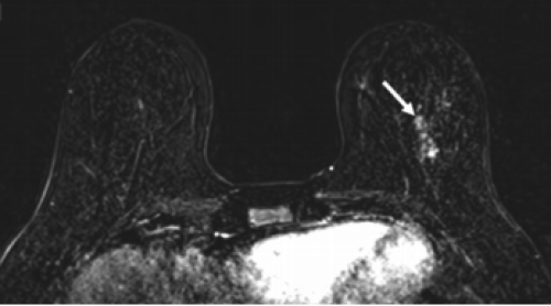 Chụp MRI có thể phát hiện ung thư vú