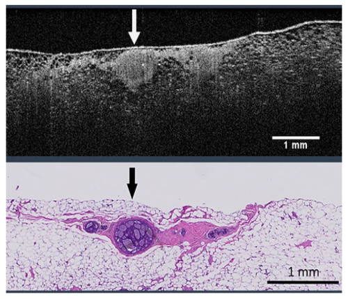 Chụp cắt lớp vi tính quang học (OCT) hỗ trợ phát hiện ung thư vú sớm