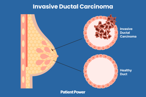 Ung thư vú xâm lấn – Đặc điểm, chẩn đoán và điều trị