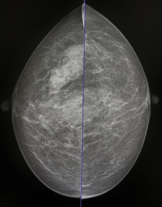 Chụp X-quang vú (Mammography) – Phương pháp quan trọng trong tầm soát ung thư vú